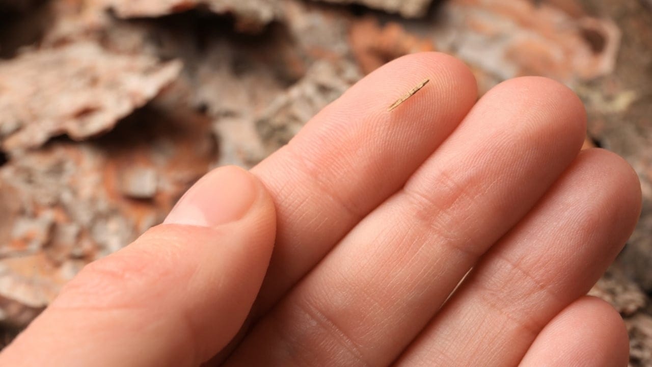 15 Ingenious Life Hacks from 100 Years Ago That Still Work - woman with splinter in her finger ss2275784915 dpdgm
